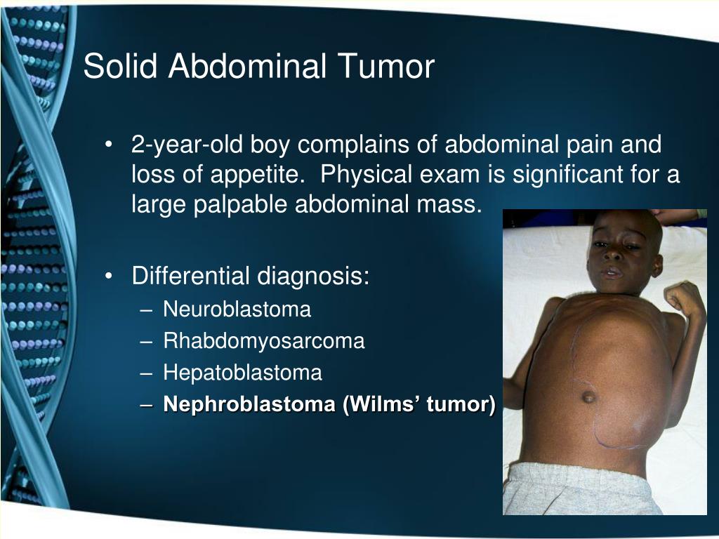 PPT Pediatric Abdominal Tumors A Focus on Wilms’ Tumor PowerPoint