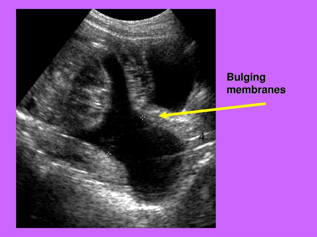 PPT Fetal Biometry PowerPoint Presentation, free download ID1266626