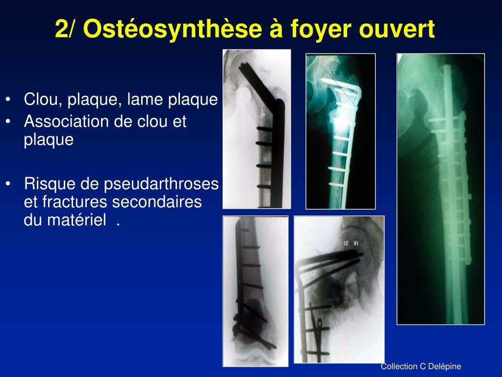 PPT Cancer secondaire des os PowerPoint Presentation, free download