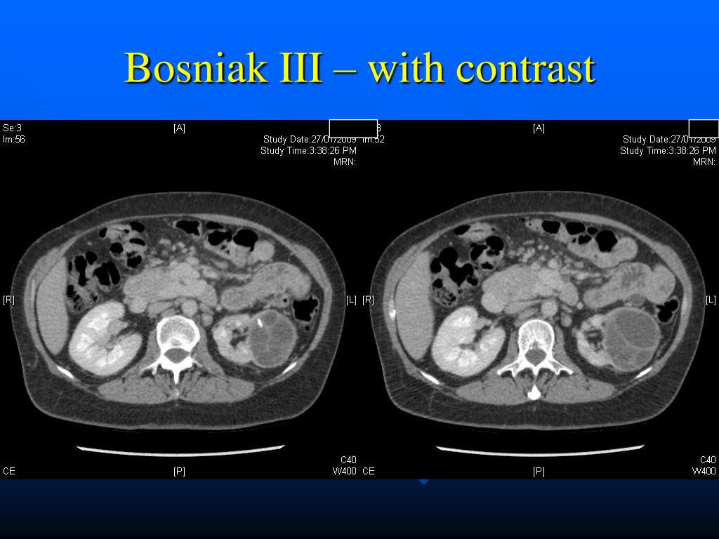 PPT Renal Cystic Disease PowerPoint Presentation, free download ID