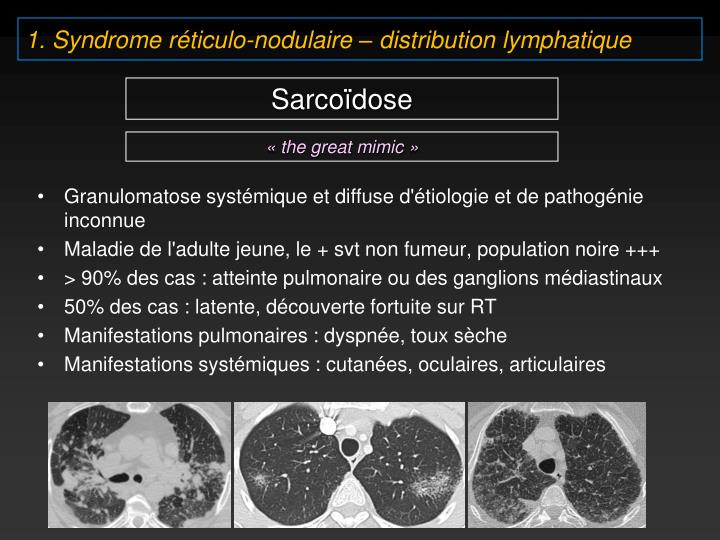 PPT 6. Pneumopathie interstitielle aiguë (AIP