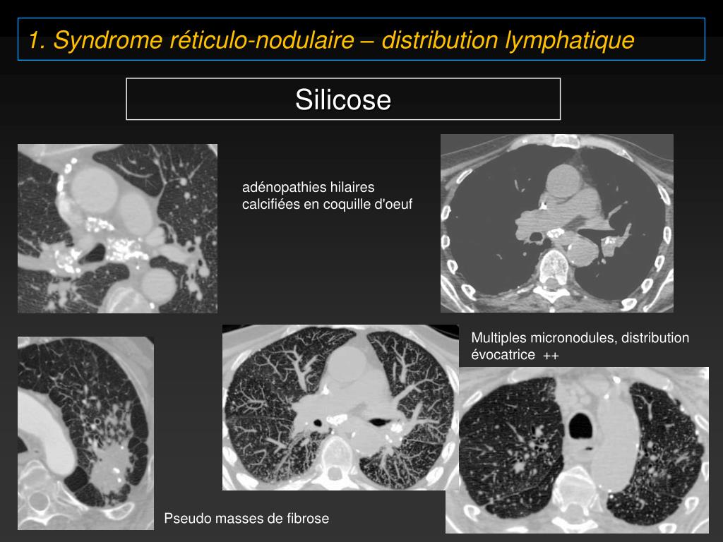 PPT 6. Pneumopathie interstitielle aiguë (AIP