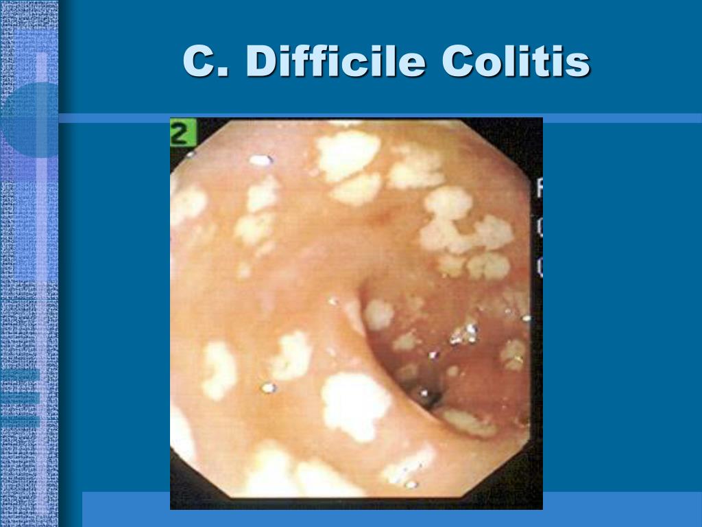 PPT Colonoscopy PowerPoint Presentation, free download