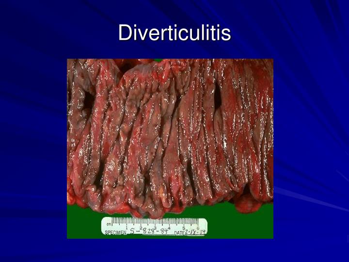 PPT Inflammatory Bowel Disease, Diverticulitis, and Inflammatory