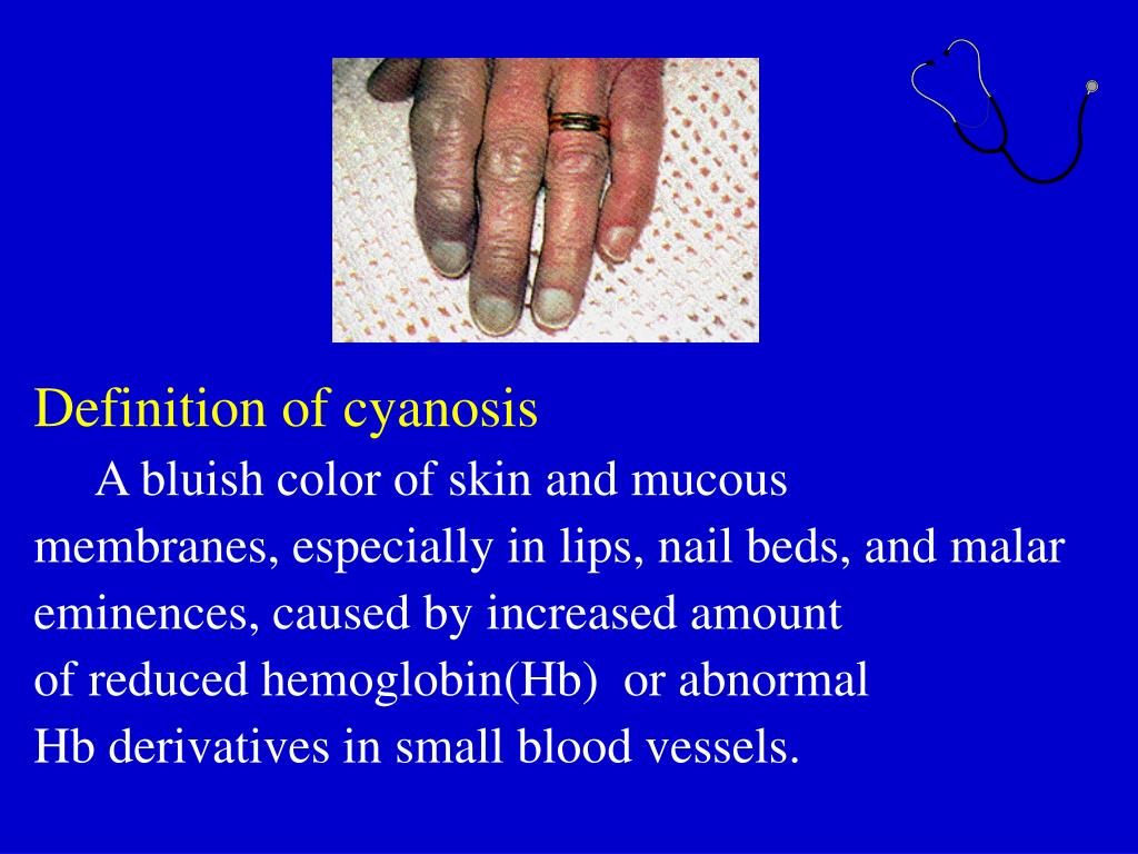 PPT Physical Diagnosis Cyanosis PowerPoint Presentation, free