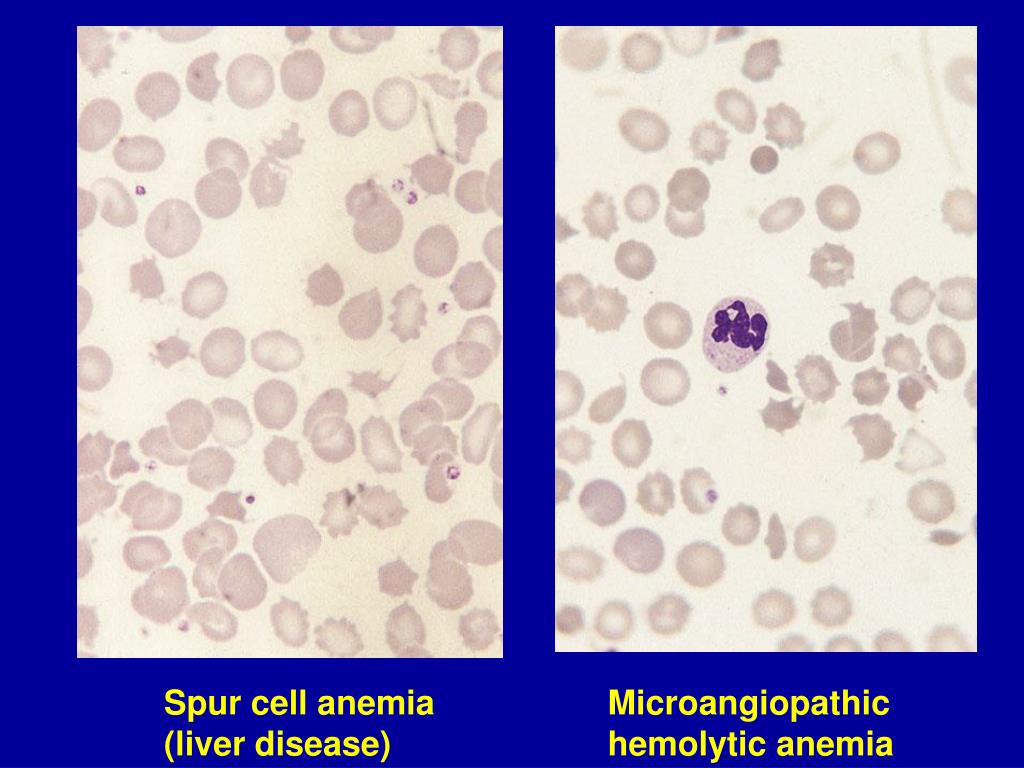 PPT EVALUATION OF THE ANEMIC PATIENT PowerPoint Presentation, free