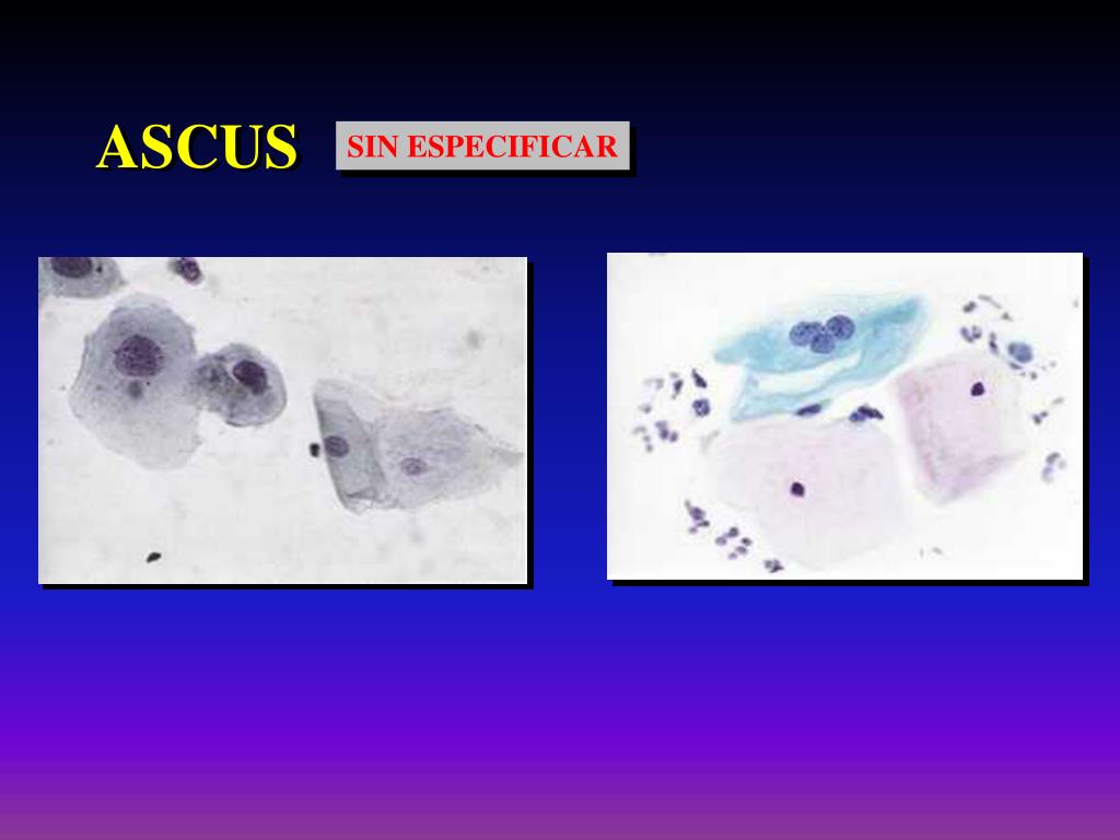 PPT ASCUS ¿Diagnóstico o prevención? PowerPoint Presentation, free