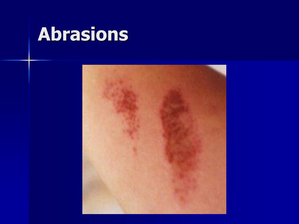 PPT Wound Care PowerPoint Presentation, free download ID134758