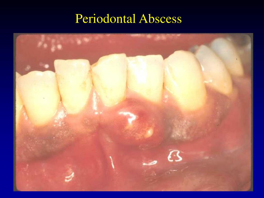 PPT ACUTE PERIODONTAL CONDITIONS PowerPoint Presentation, free