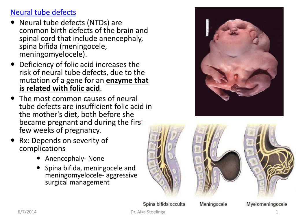 PPT Neural tube defects PowerPoint Presentation, free download ID