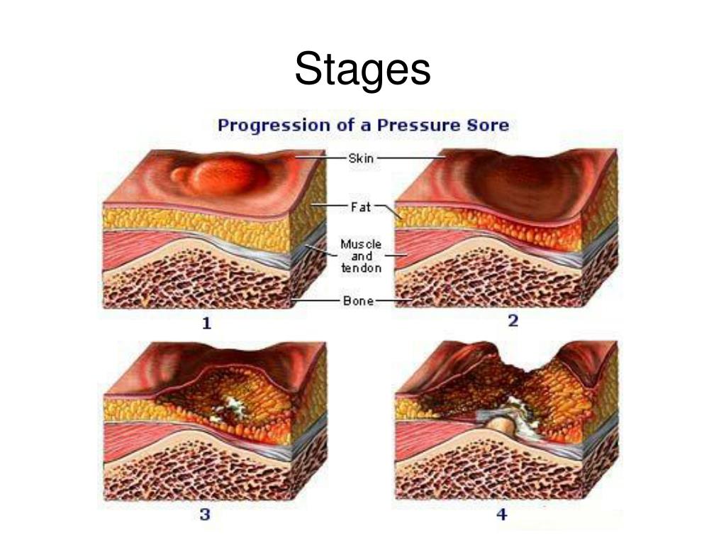 PPT Wounds Care and Treatment PowerPoint Presentation, free download
