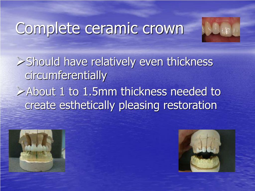 PPT ALL CERAMIC RESTORATIONS PowerPoint Presentation, free download ID1403596