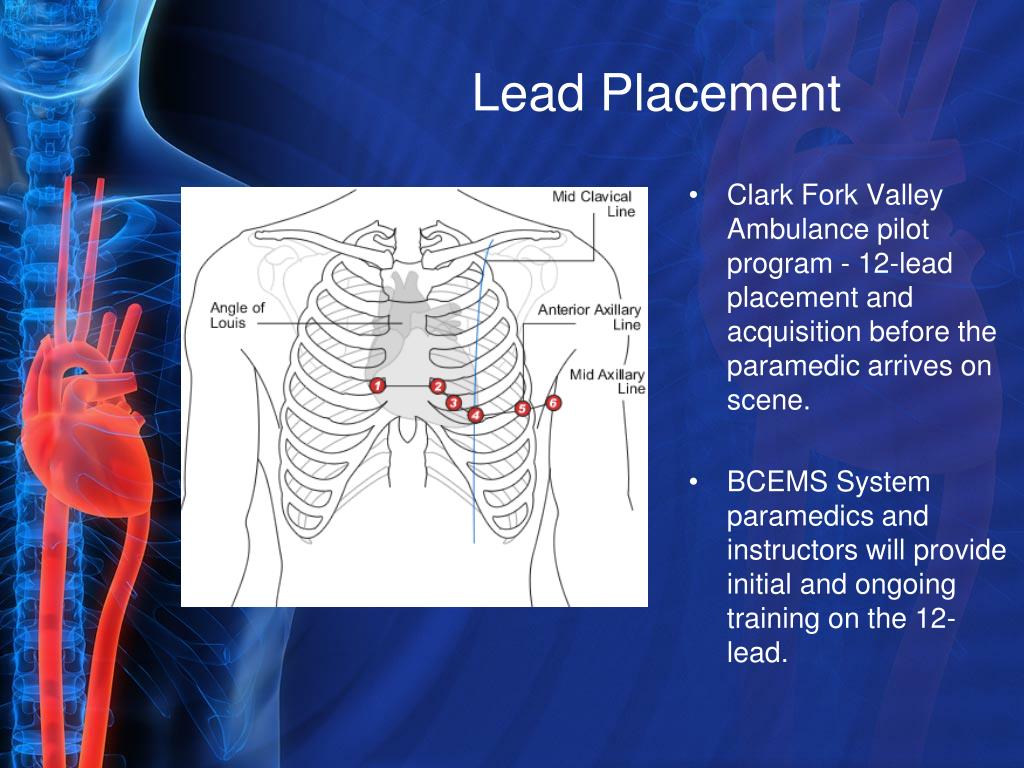 PPT STEMI PowerPoint Presentation, free download ID1423479
