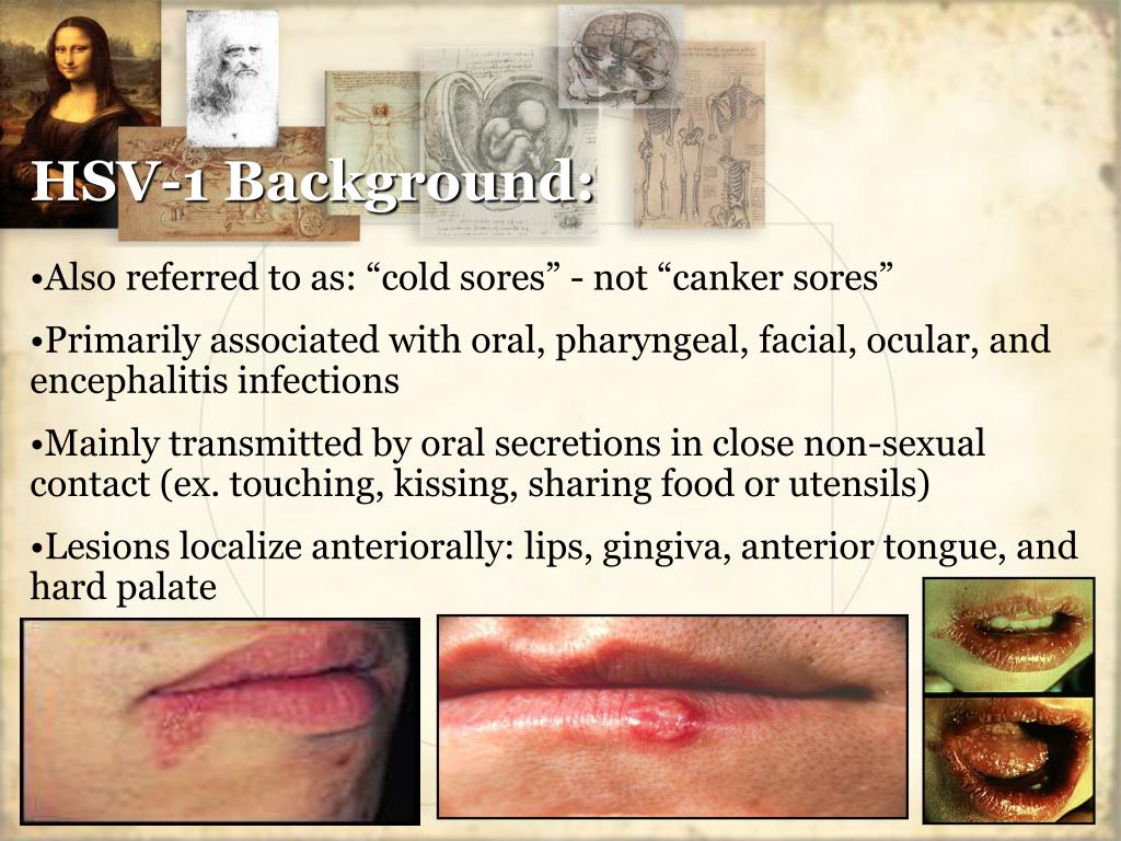 PPT HSV Herpes Simplex Virus Micr. 401 Virology Case Study 15