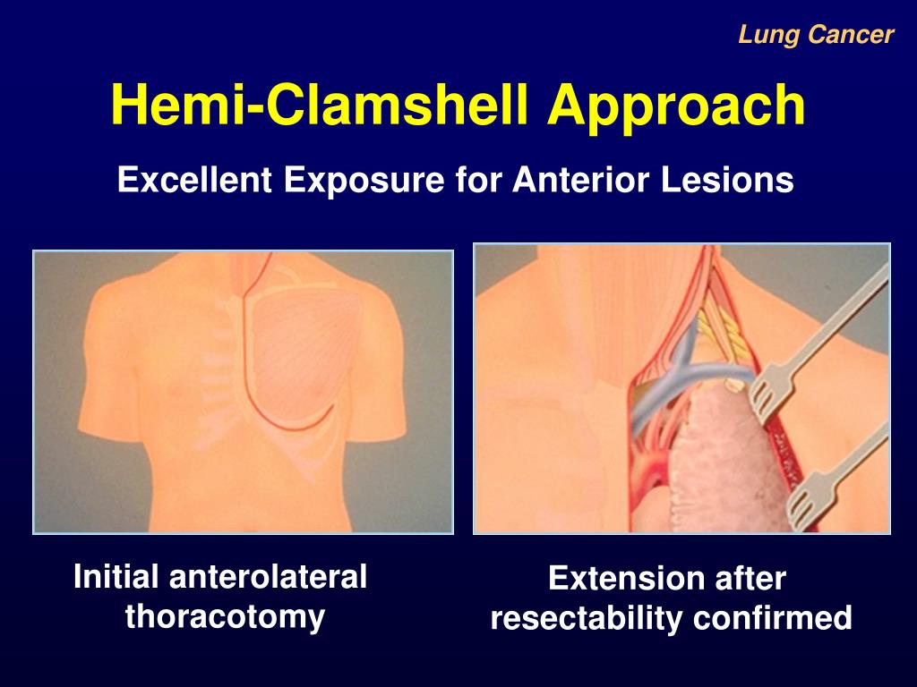 PPT Superior Sulcus Resection PowerPoint Presentation, free download ID1432057