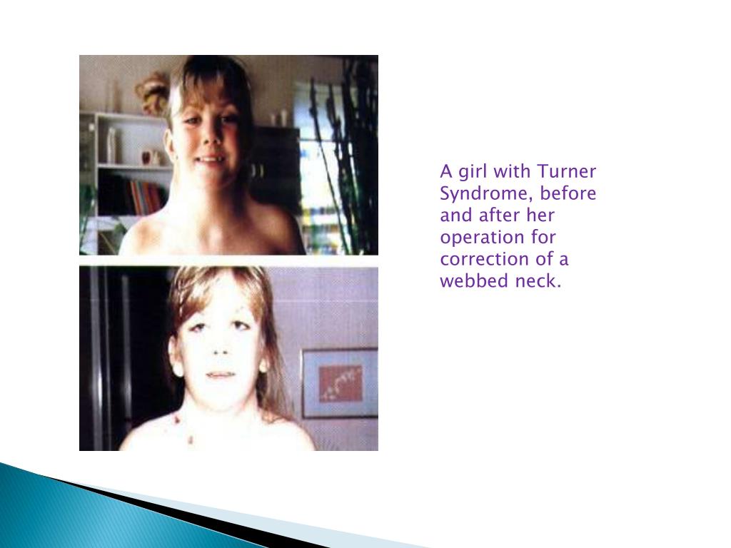 PPT Turner Syndrome PowerPoint Presentation, free download ID1457293