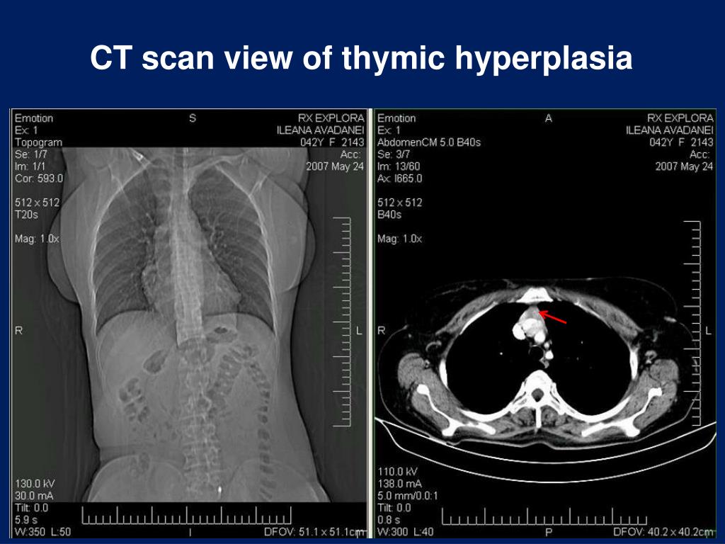 PPT ThymoThyroid Associations Clinical and Pathological Aspects PowerPoint Presentation ID