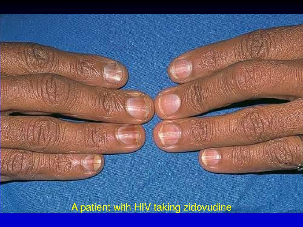Pseudomonas Nail Infection Icd 10 Nail Ftempo