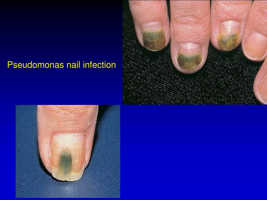 Pseudomonas Nail Infection Icd 10 Nail Ftempo