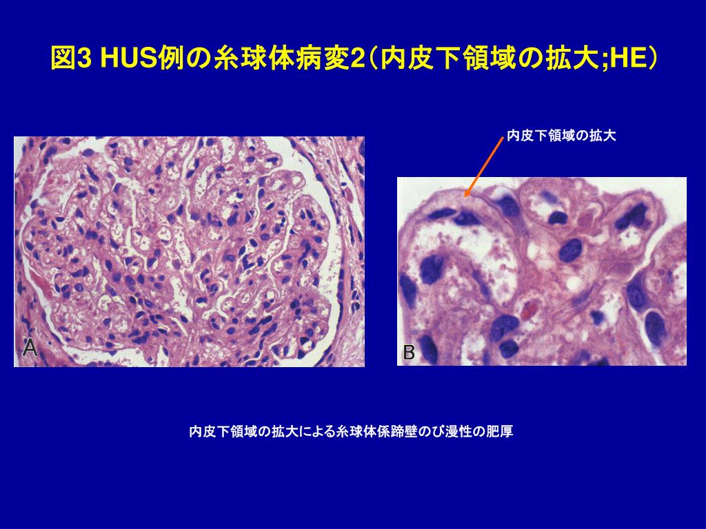 PPT 表 1 血栓性微小血管障害（ TMA ）を示す 腎疾患の対比 PowerPoint