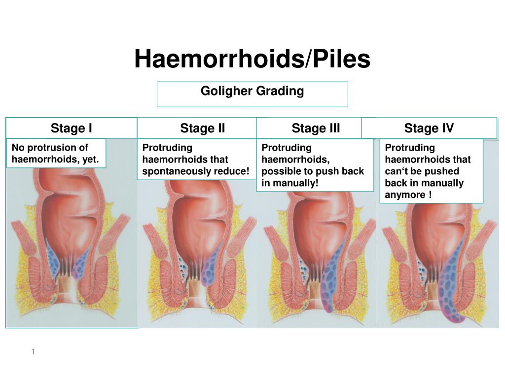 PPT Goligher Grading PowerPoint Presentation, free download ID161175