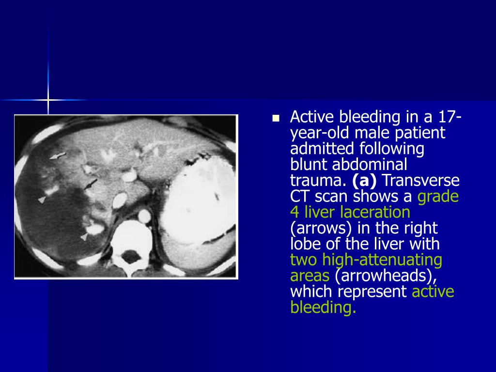 PPT CT Criteria for Management of Blunt Liver Trauma Correlation
