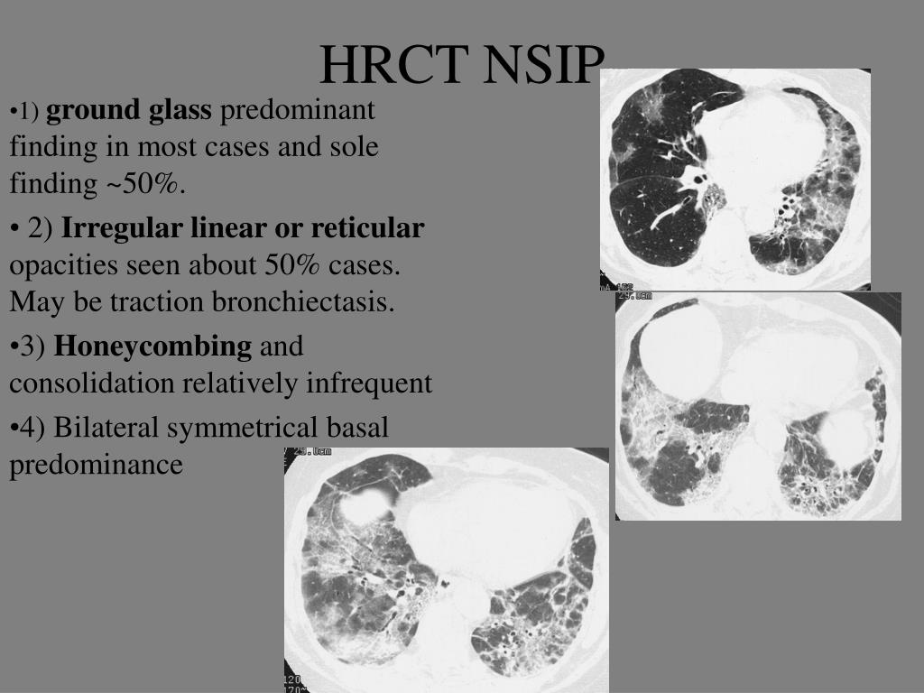 PPT Radiology of Connective Tissue Disease associated Interstitial