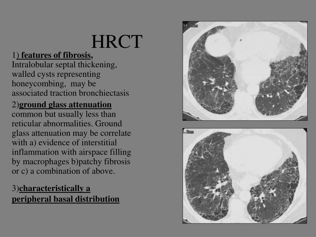 PPT Radiology of Connective Tissue Disease associated Interstitial