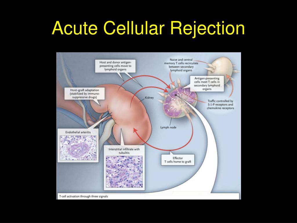 PPT Renal Transplantation PowerPoint Presentation, free download ID