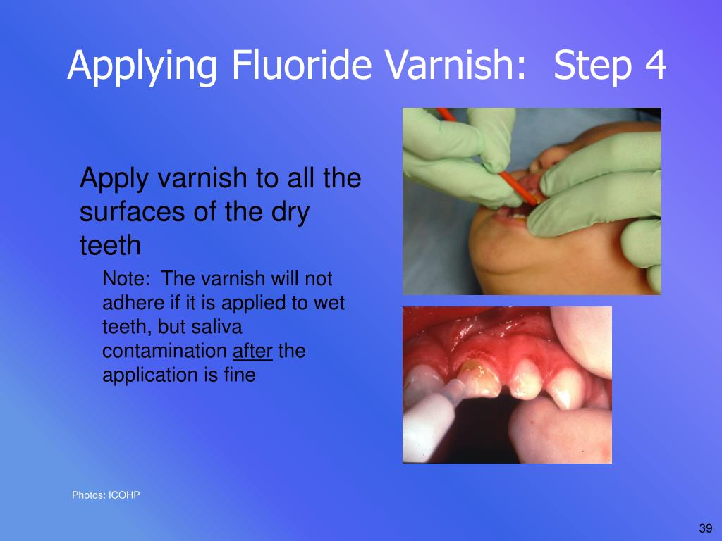 PPT How Fluoride Varnish Combats Early Childhood Caries Daniel Ravel