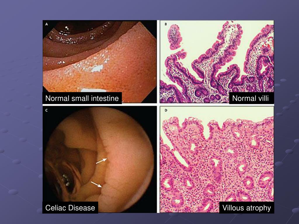 PPT Celiac Disease PowerPoint Presentation ID210653