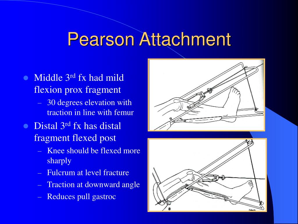 PPT Orthopaedic Traction PowerPoint Presentation ID210938