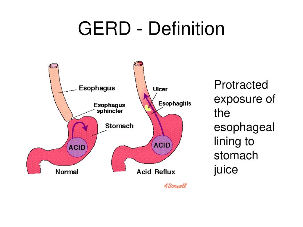 PPT Swallowing Difficulty & Pain PowerPoint Presentation, free