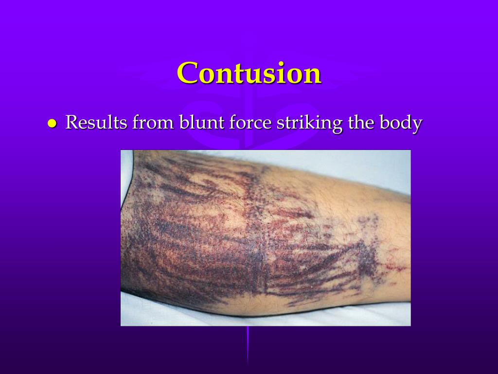PPT SoftTissue Injuries PowerPoint Presentation, free download ID