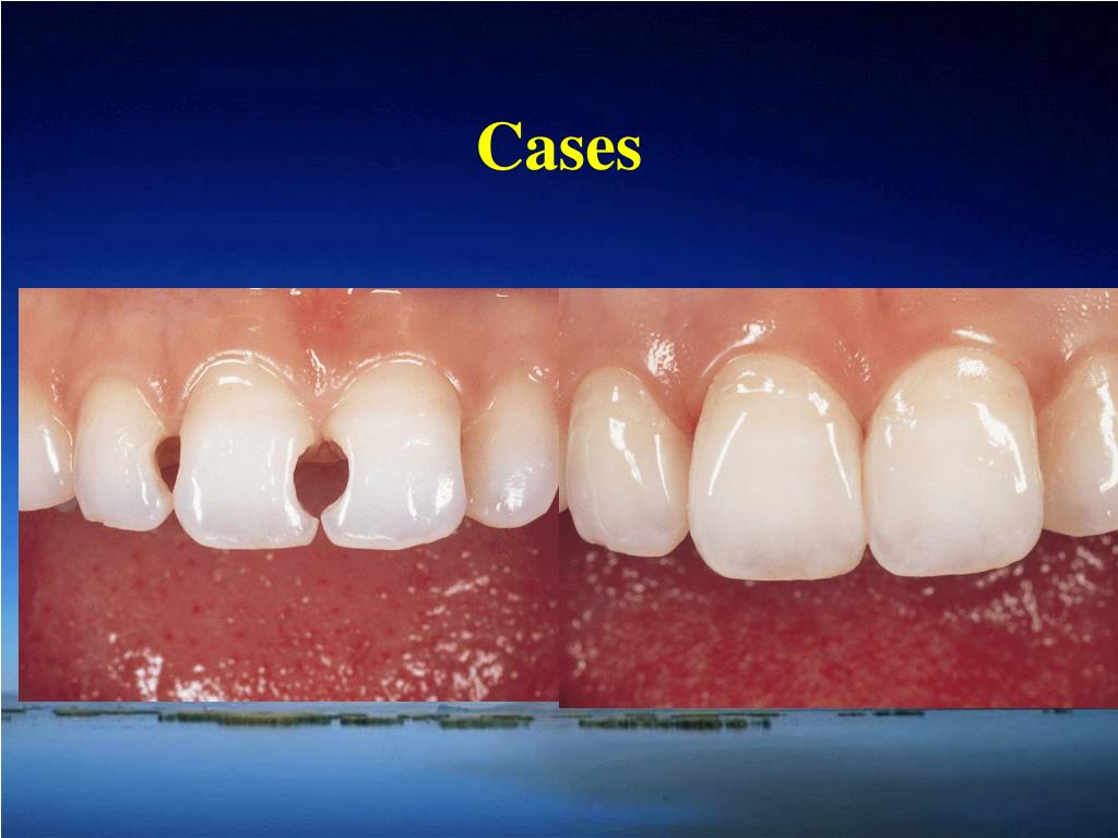 PPT Operative Dentistry PowerPoint Presentation, free download ID