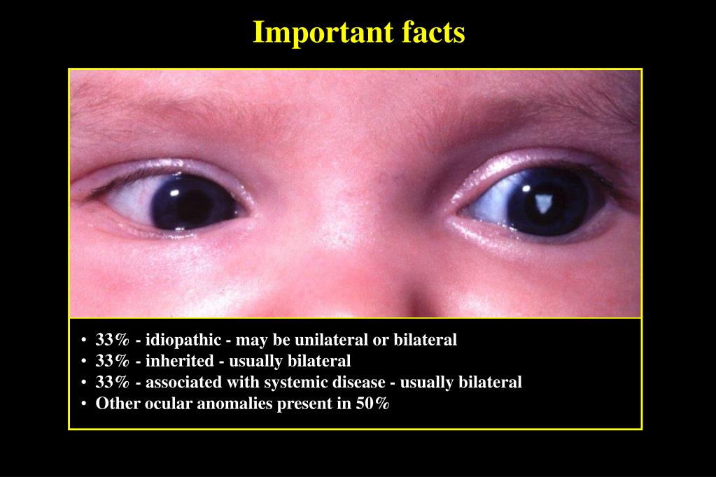 Ppt - Congenital Cataract Powerpoint Presentation, Free Download - Id:225627