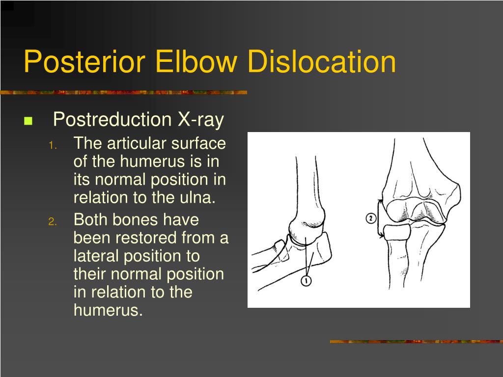 PPT Dislocation and Fracture Reductions PowerPoint Presentation ID