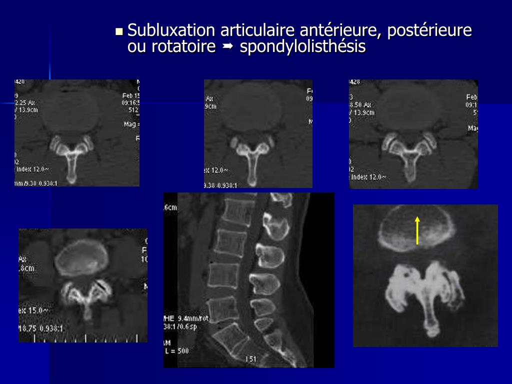 PPT Imagerie du rachis lombaire dégénératif PowerPoint