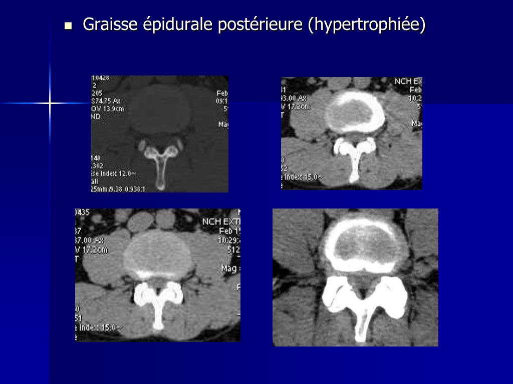 PPT Imagerie du rachis lombaire dégénératif PowerPoint