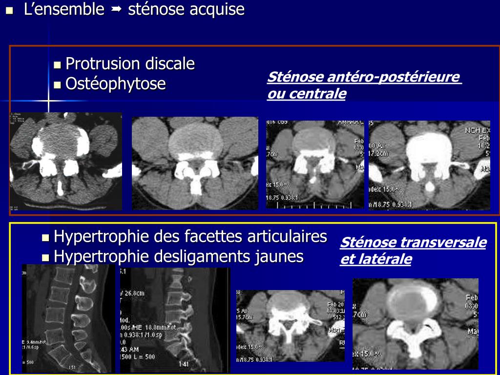 PPT Imagerie du rachis lombaire dégénératif PowerPoint