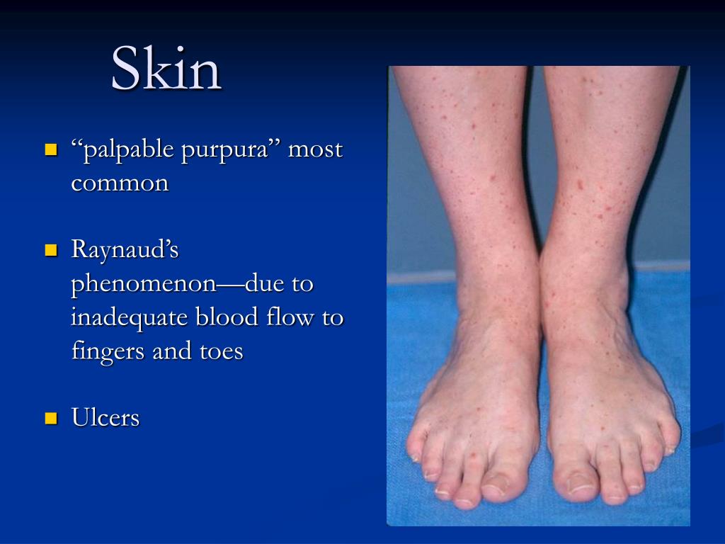 PPT Wegener’s Granulomatosis PowerPoint Presentation, free download