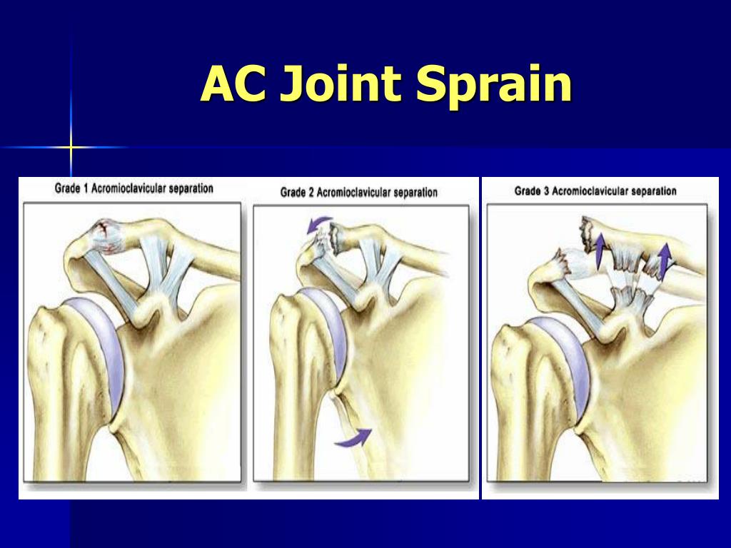 PPT COMMON SHOULDER PROBLEMS PowerPoint Presentation ID245881