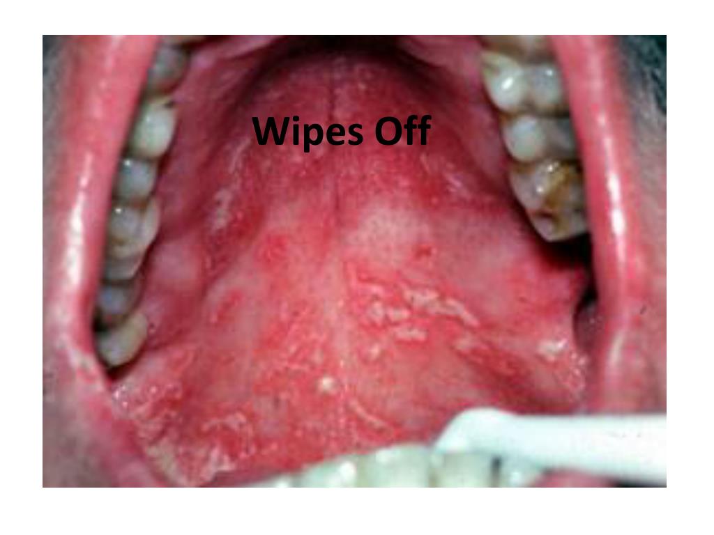 PPT Fordyce Granules PowerPoint Presentation, free download ID248523