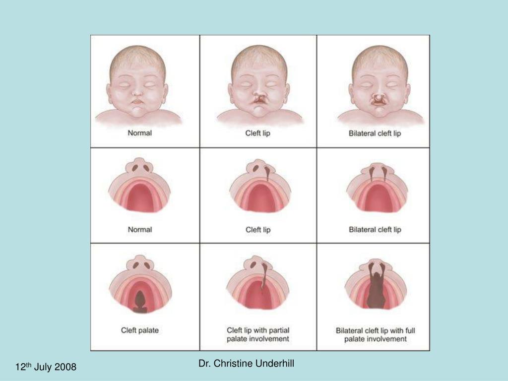 Management of cleft lip and palate: a team approach