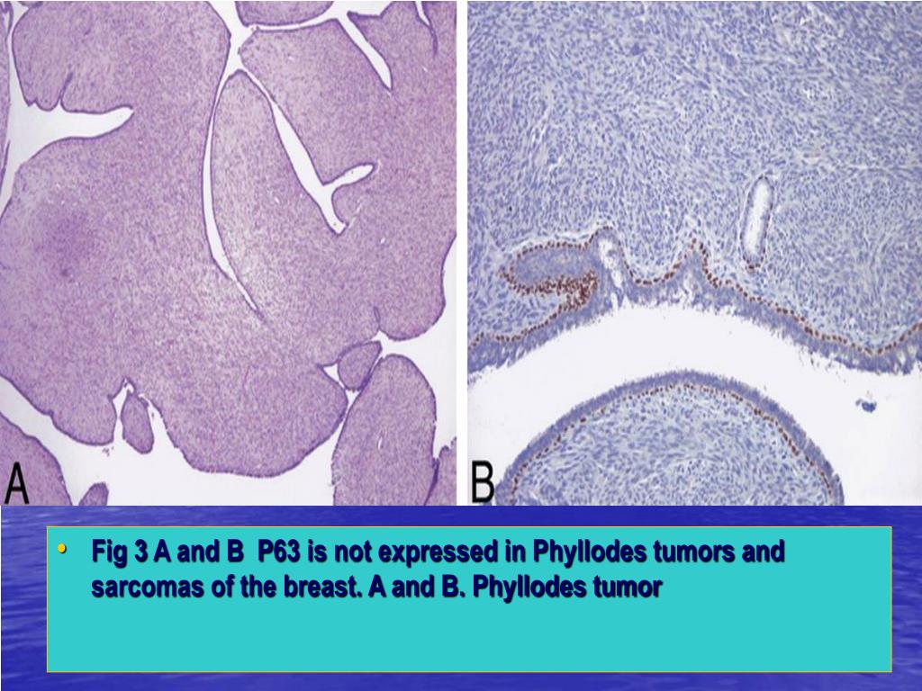 PPT P63 Expression in Breast Cancer PowerPoint Presentation, free