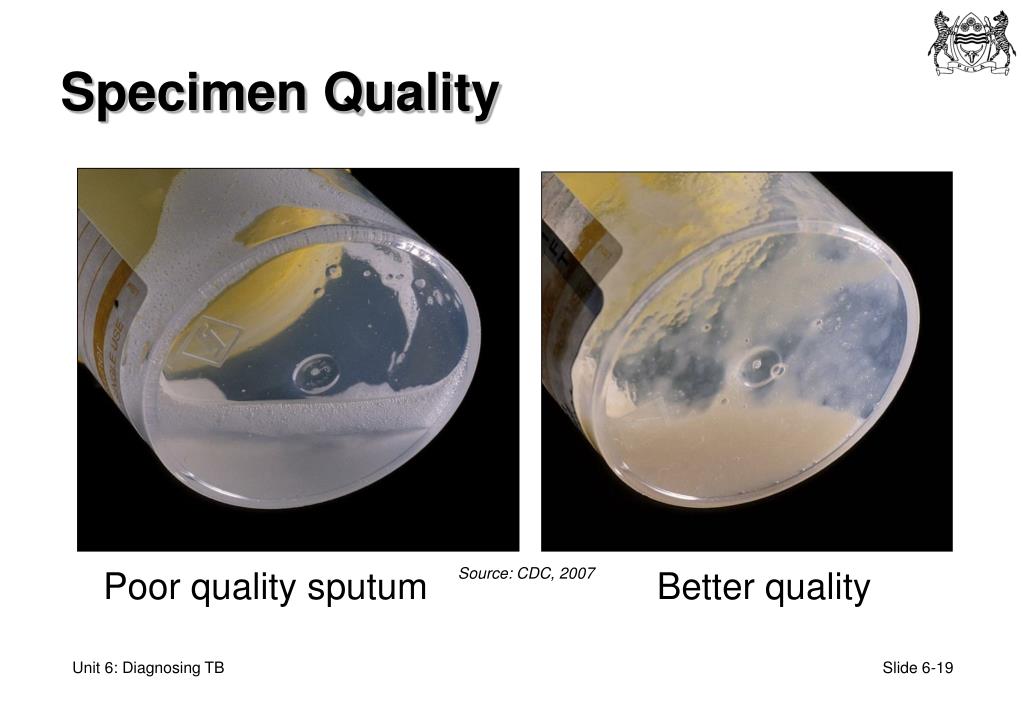 PPT Unit 6 Diagnosing TB PowerPoint Presentation, free download ID