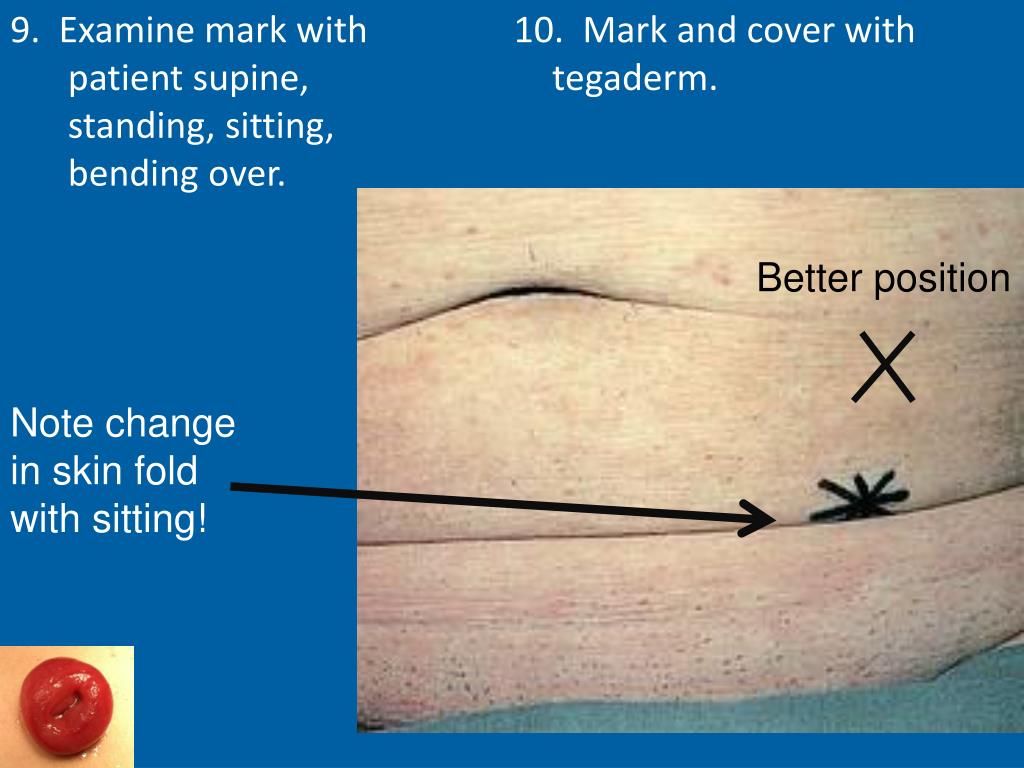 PPT The Difficult Stoma PowerPoint Presentation, free download ID257323