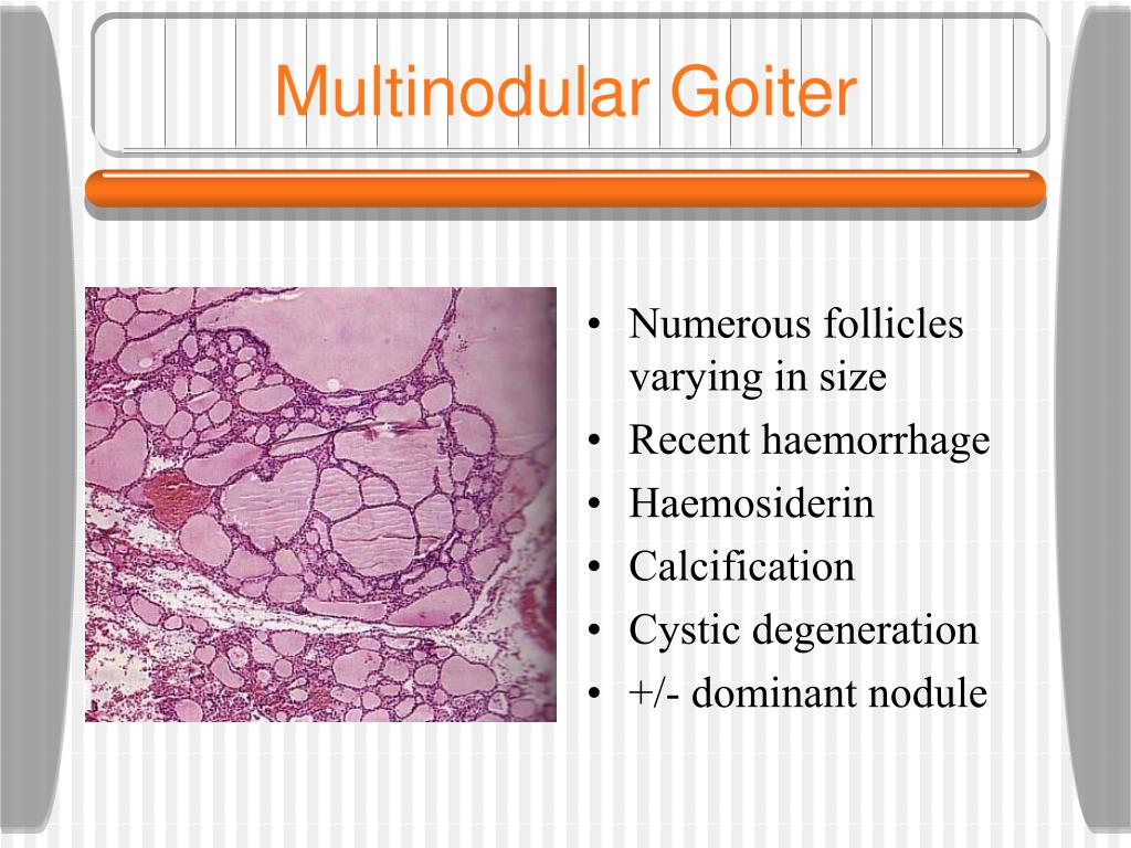 multinodular goiter multiple thyroid nodules and cancer Singapp