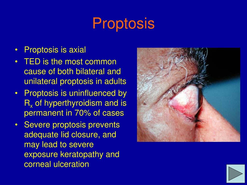 PPT Thyroid Eye Disease PowerPoint Presentation, free download ID