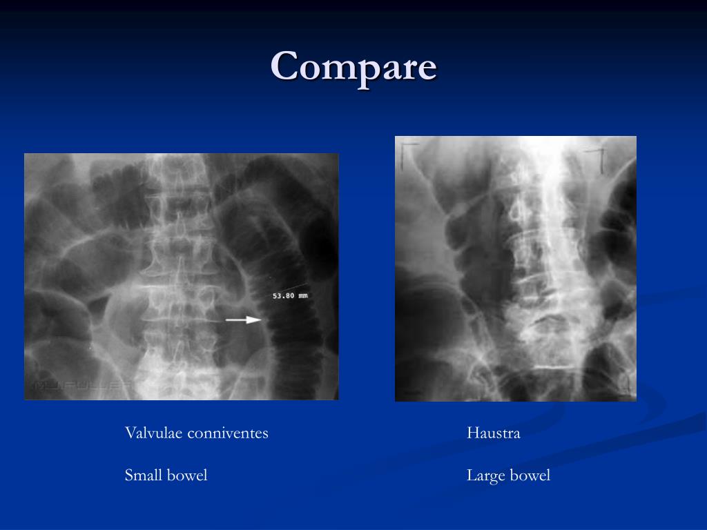 PPT Radiography of the GI System PowerPoint Presentation ID280707